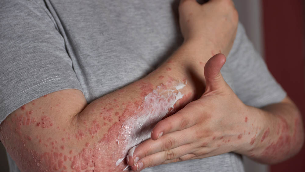 Applying moisturizer to skin with psoriasis